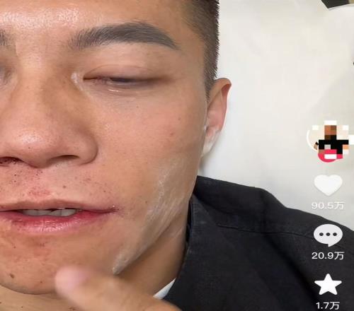 扇耳光大賽倒地的中國選手再發(fā)聲：眼睛不時疼痛，仍希望參賽