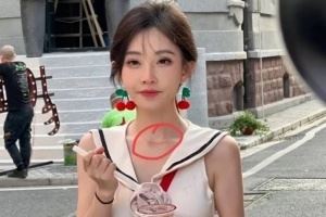 冯提莫公开甲状腺手术疤痕称其为“老天赐予的美丽微笑线”